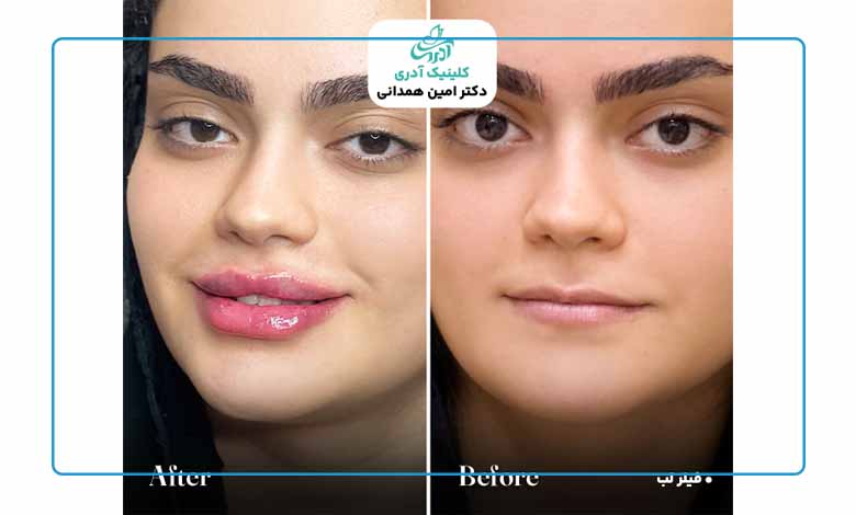 نمونه کار فیلر لب در کلینیک زیبایی آدری