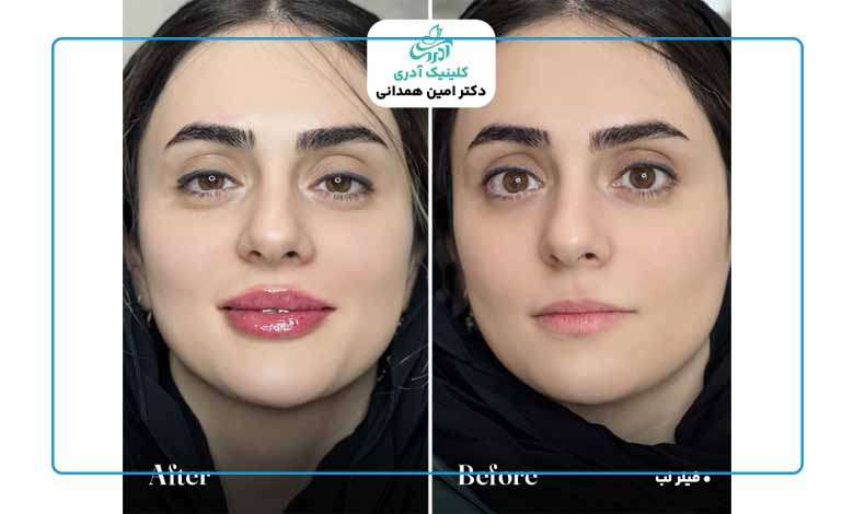نمونه کار فیلر لب در کلینیک آدری