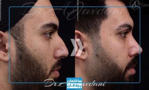 نمونه کار عمل بینی مردانه توسط دکتر جاودانی