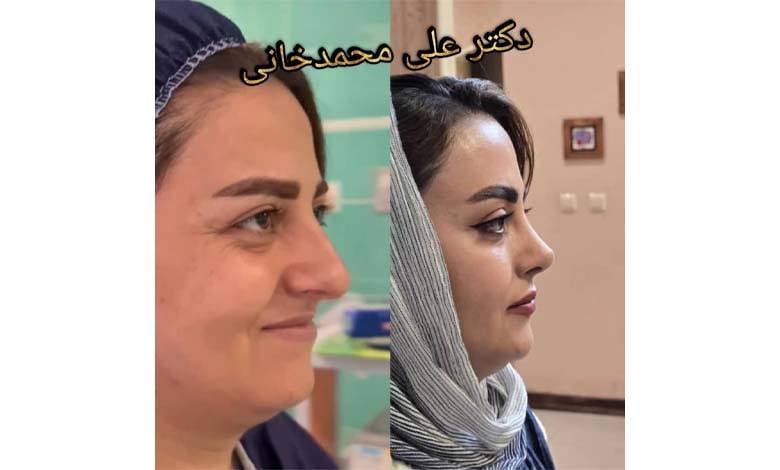نمونه کار جراحی بینی دکتر محمدخانی