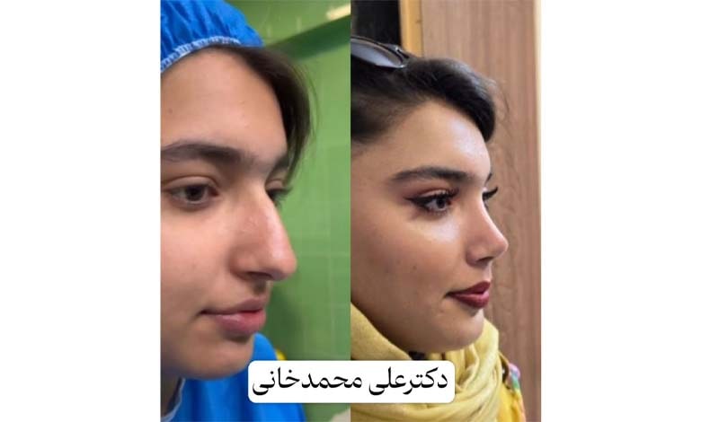 نمونه کار عمل بینی دکتر محمدخانی