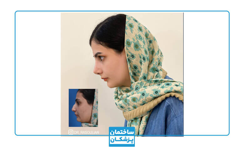 نمونه کار جراحی بینی دکتر بشیر رسولیان