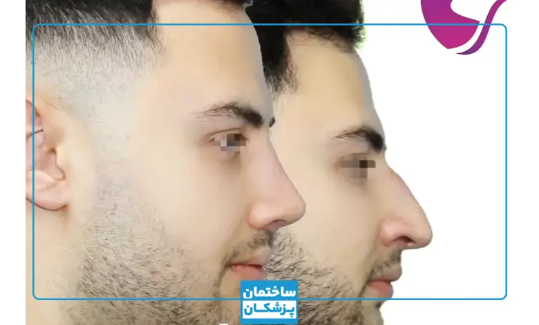 نمونه کار دکتر فرزاد فرد جراح بینی مشهد
