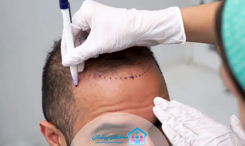 معرفی بهترین کلینیک کاشت مو مشهد