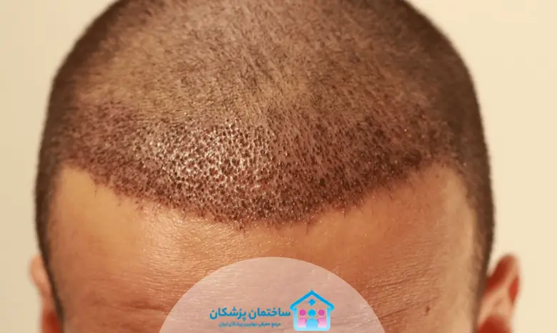 هزینه کاشت مو در مشهد