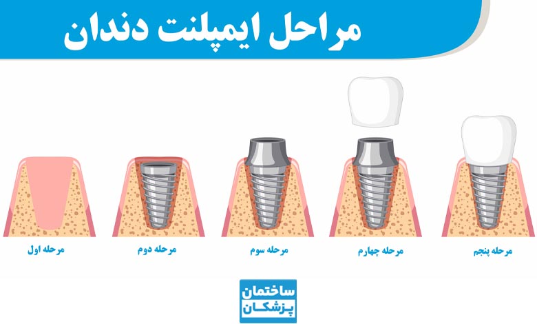 اینفوگرافیک مراحل ایمپلنت دندان