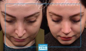 تصویر قبل و بعد از عمل بینی با دکتر جاودانی