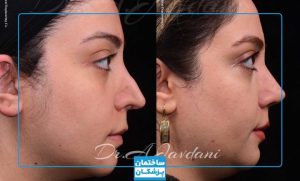 نمونه کار جراحی بینی با دکتر جاودانی