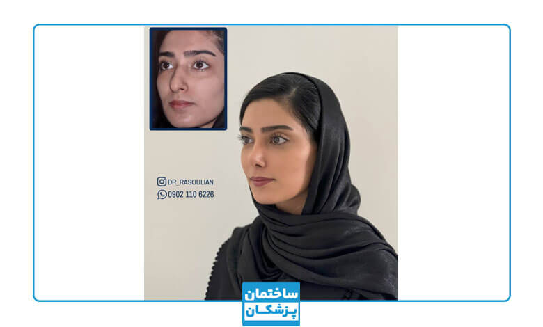 نمونه کار عمل بینی دکتر رسولیان