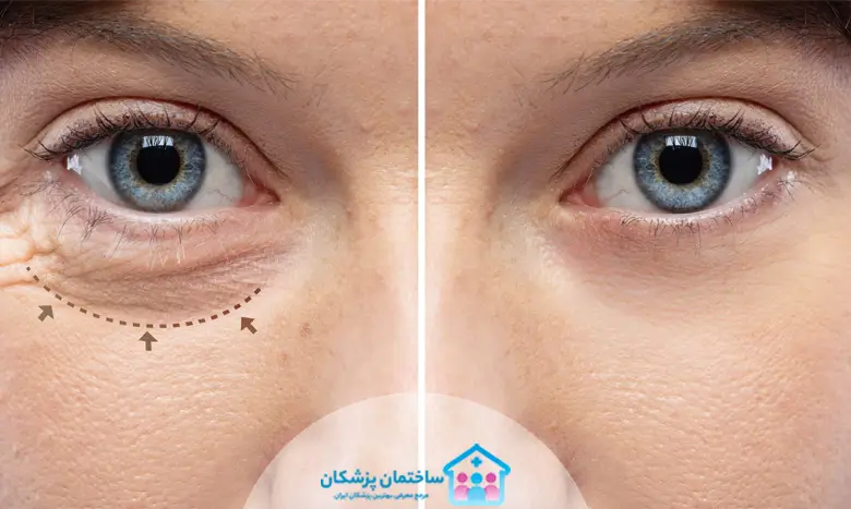 هزینه عمل بلفاروپلاستی در اصفهان