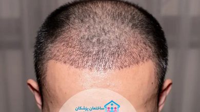 بهترین کلینیک کاشت مو در تهران