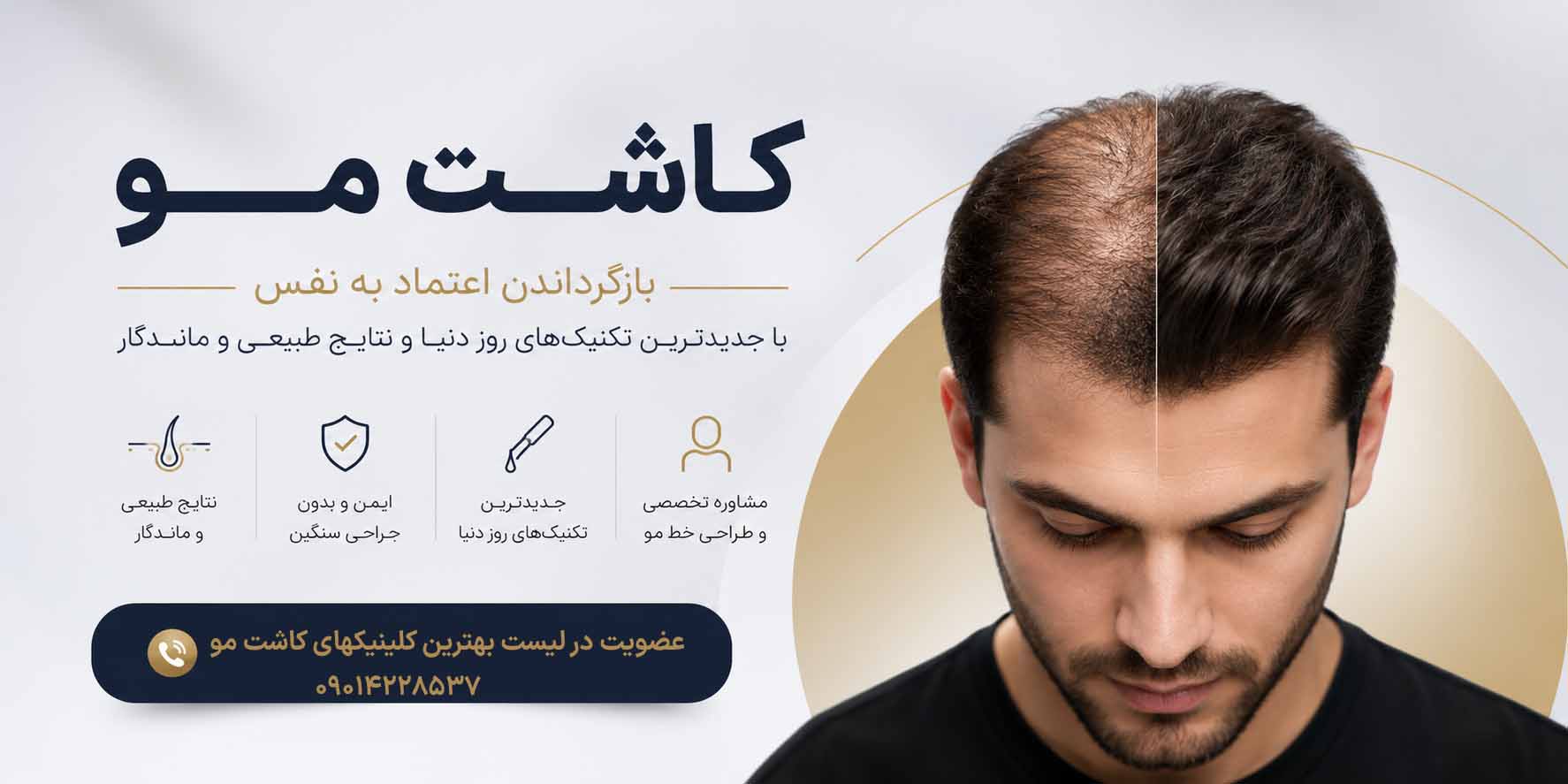 کاشت مو طبیعی در بهترین کلینیک کاشت مو در تهران