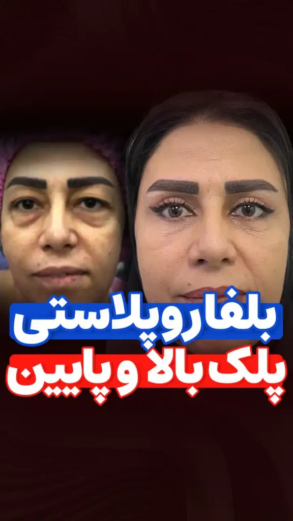 نمونه کار بلفاروپلاستی پلک بالا و پایین توسط دکتر رضایی