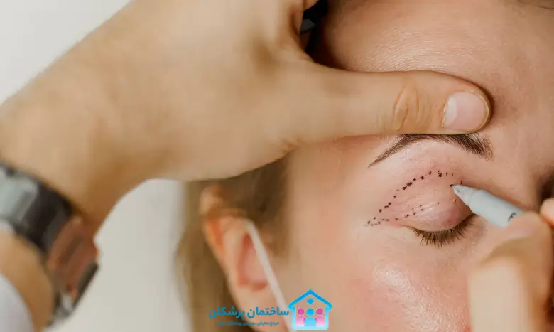 عمل بلفاروپلاستی با لیزر چگونه است؟