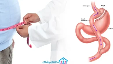 بهترین دکتر بای پس معده در تهران
