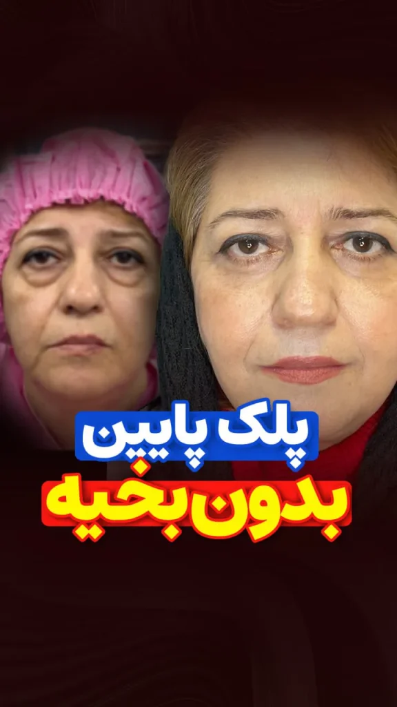 جراحی پلک پایین بدون بخیه توسط دکتر رضایی