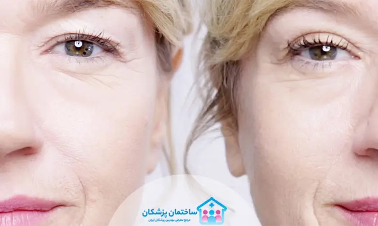 تاثیر بلفاروپلاستی رو حالت چشم