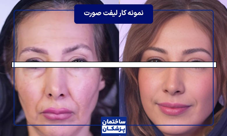 نمونه کار جراحی لیفت صورت توسط دکتر نجف بیگی