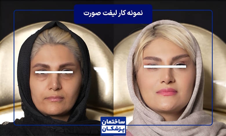 نمونه کار جراحی لیفت صورت با دکتر آرش نجف بیگی
