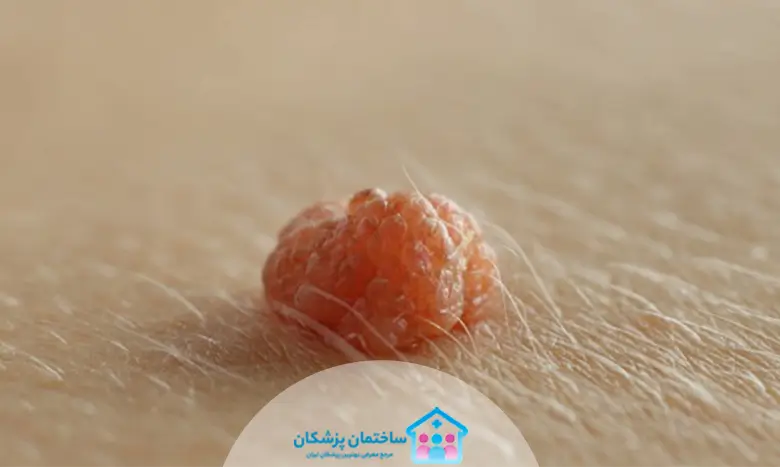لیست بهترین دکتر زگیل تناسلی در تهران