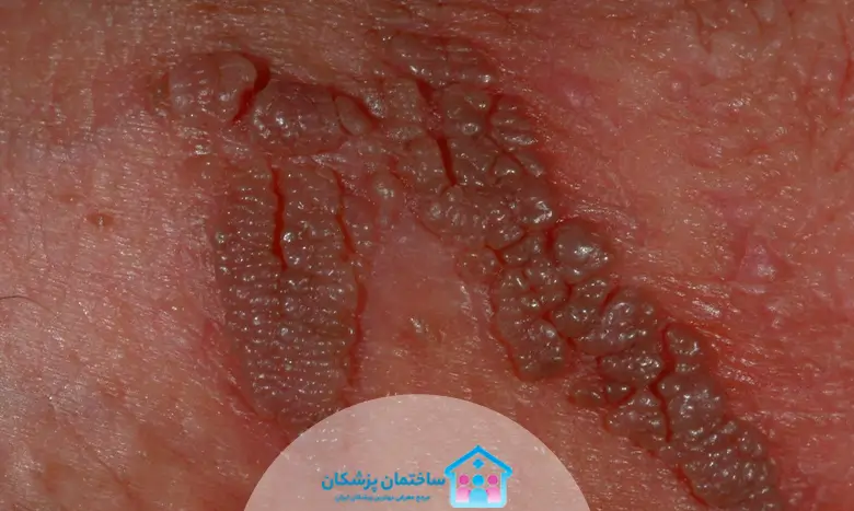 زگیل تناسلی چیست؟