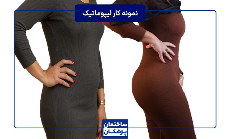 نمونه کار لیپوماتیک دکتر نجف بیگی
