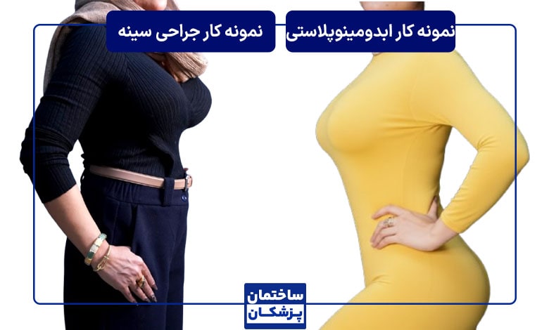 نمونه کار جراحی پلاستیک بدن توسط دکتر آرش نجف بیگی