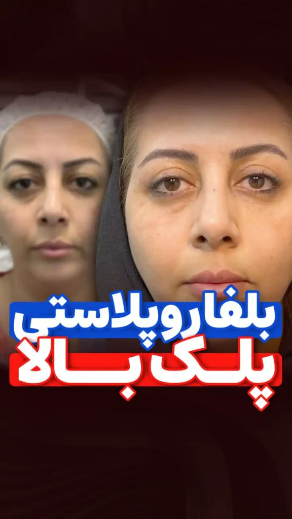 بلفاروپلاستی پلک بالا توسط دکتر رضایی