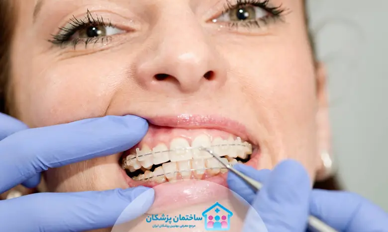 انواع روش های ارتودنسی دندان