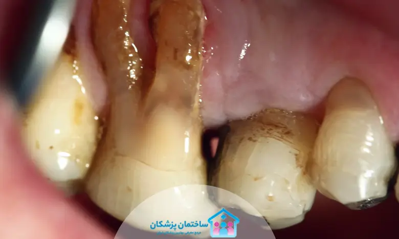 علل بروز عفونت دندان