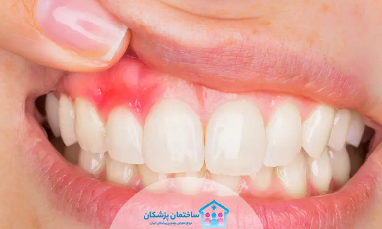 عفونت دندان یا آبسه دندان چیست