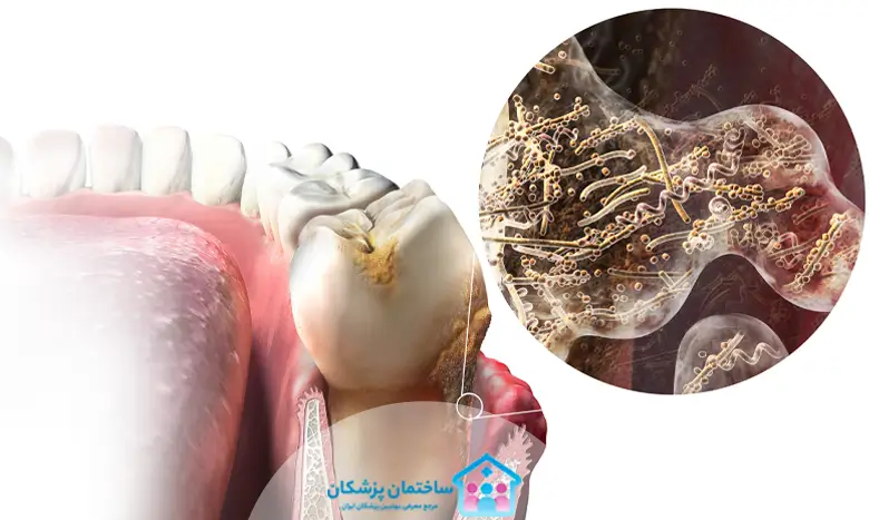 درمان خانگی عفونت دندان در خانه