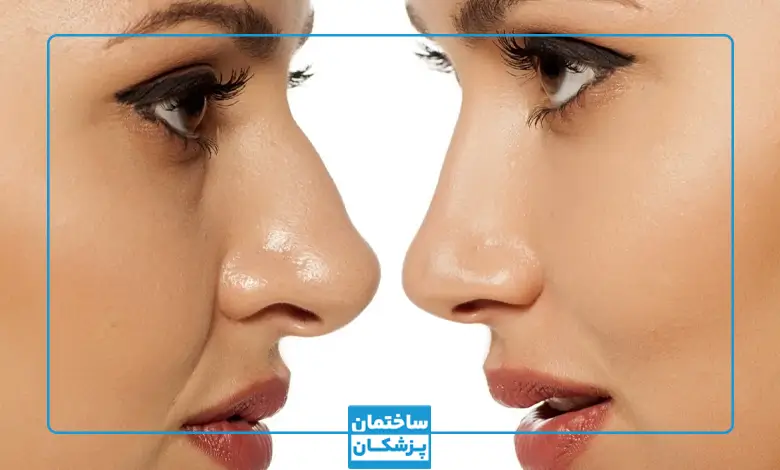 مراقبت های قبل و بعد عمل بینی ترمیمی