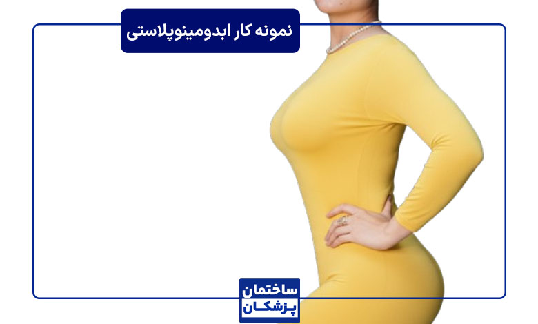 نمونه کار ابدومینوپلاستی توسط دکتر آرش نجف بیگی
