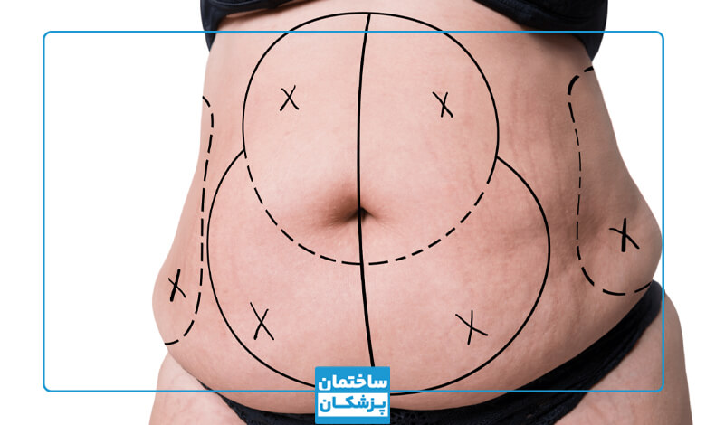 جراحی زیبایی شکم چیست