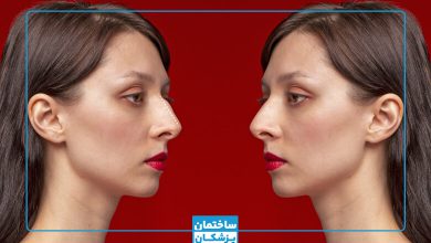 بهترین جراح بینی استخوانی در تهران