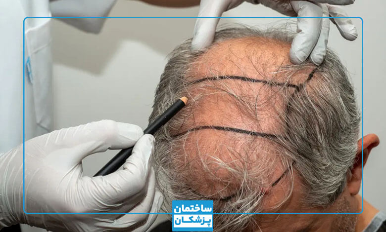 بهترین مراکز کاشت مو در ترکیه