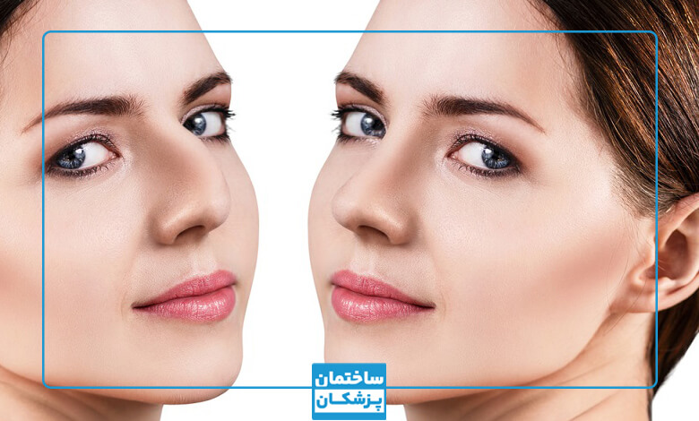 عوامل موثر بر هزینه عمل بینی