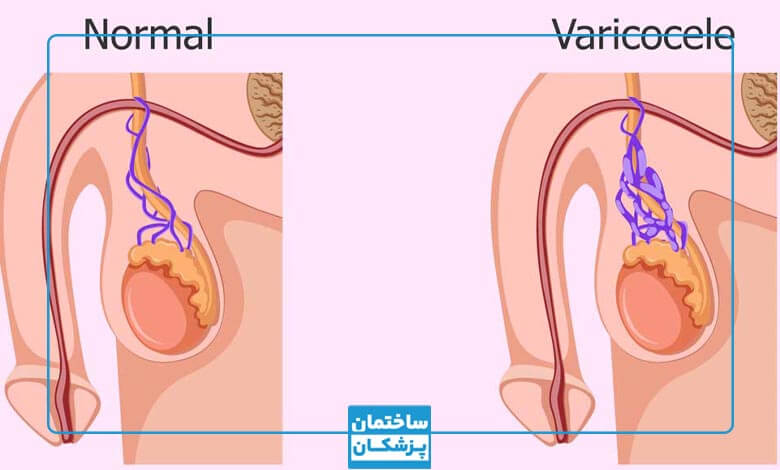 عوارض واریکوسل چیست