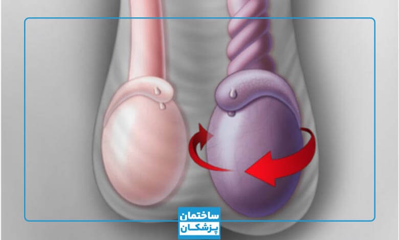 روش های درمان واریکوسل