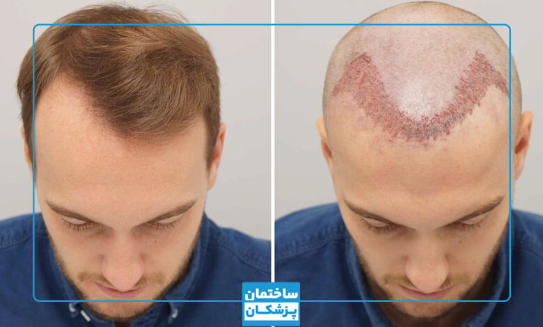 نمونه کار بهترین کلینیک کاشت مو در ترکیه