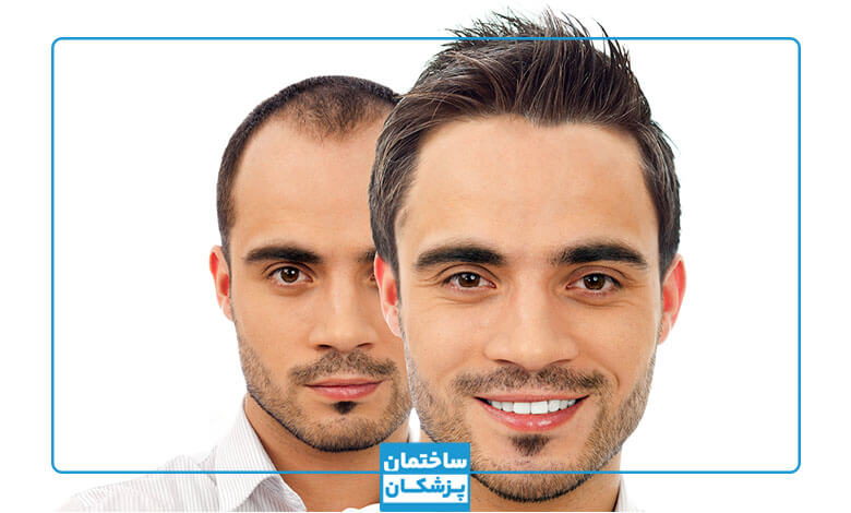 روش های کاشت مو در ترکیه