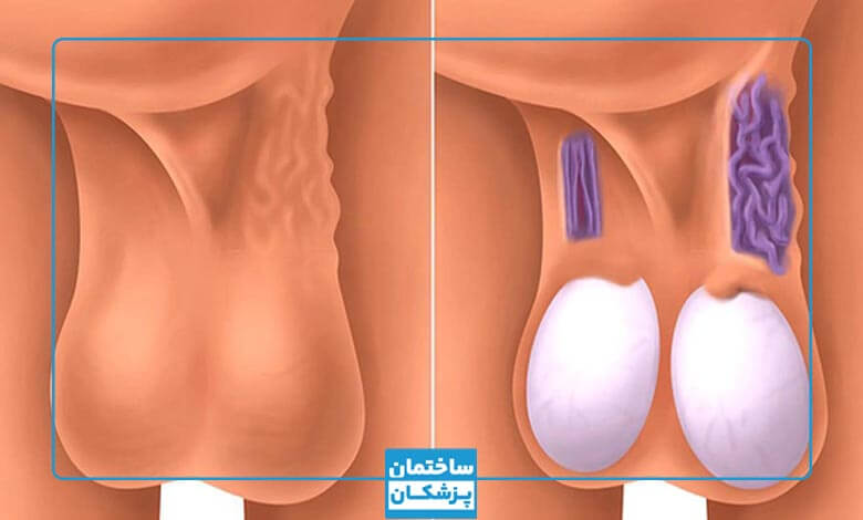 واریکوسل چیست