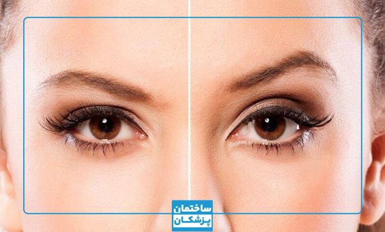 هزینه لیفت شقیقه در تهران