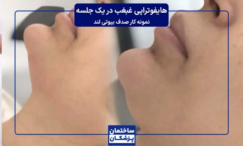 رفع غبغب با یکوجلسه هایفوتراپی نمونه کار صدف بیوتی لند