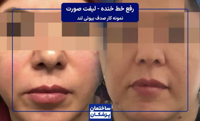 رفع خط خنده و لیفت صورت با هایفو در صدف بیوتی لند