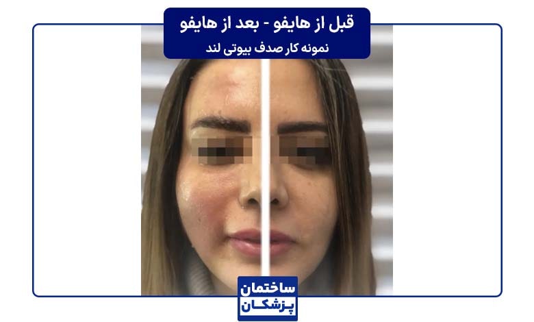 قبل و بعد از هایفوتراپی در صدف بیوتی لند