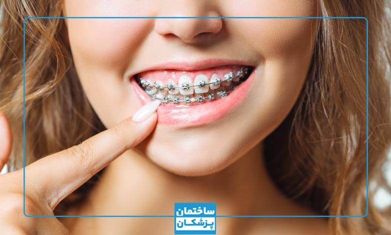 تاثیر نوع درمان ارتودنسی بر هزینه