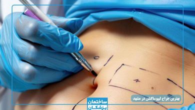 بهترین جراح لیپوساکشن در مشهد
