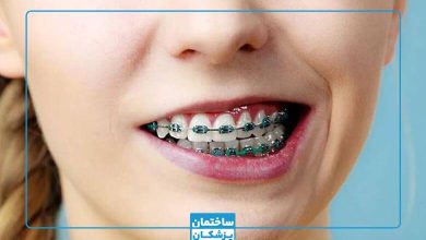 هزینه ارتودنسی در تهران
